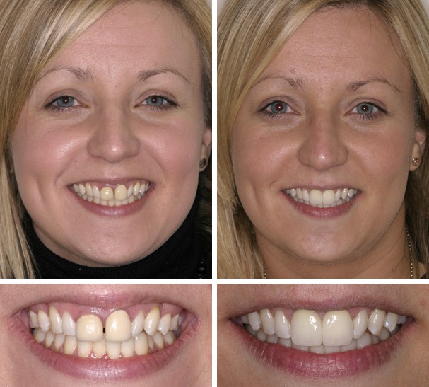 Smile Gallery - before and after photos