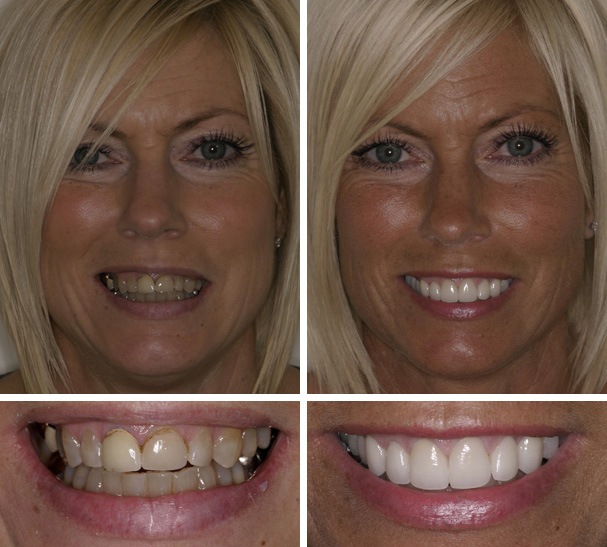 Smile Gallery - before and after photos