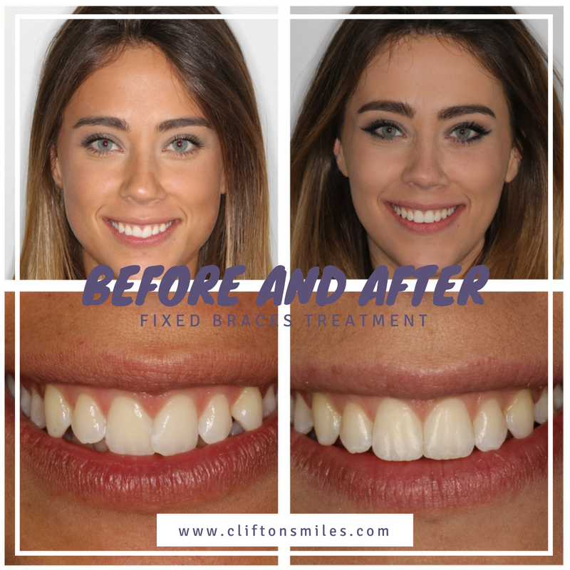Before and after braces