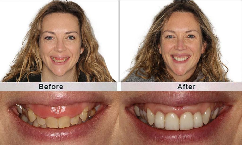 gum reshaping A before and after